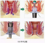 <b>TST痔疮手术费用及优势</b>