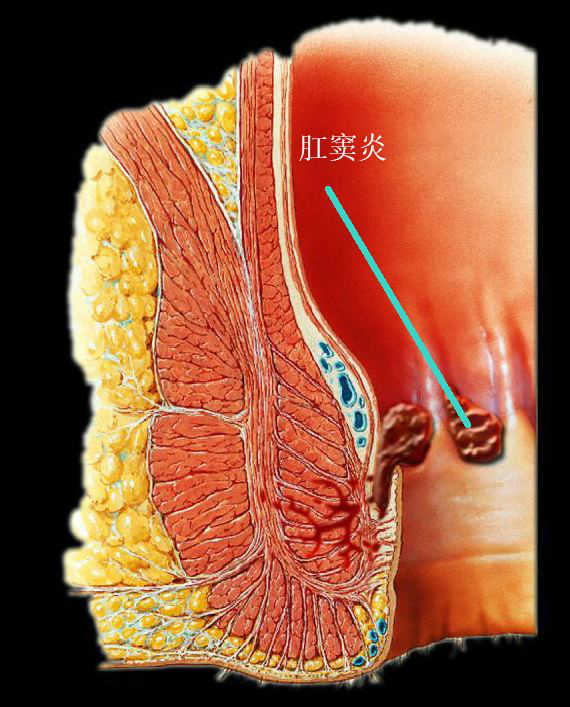 什么是肛窦炎