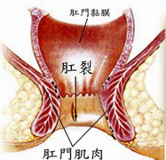 <b>大便出血是什么原因</b>