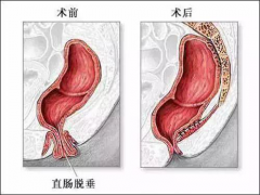 <b>为什么肛周有小肉球</b>