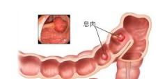 <b>直肠息肉的危害有哪些</b>