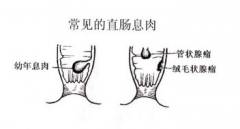 <b>直肠息肉的治疗方法有哪些</b>