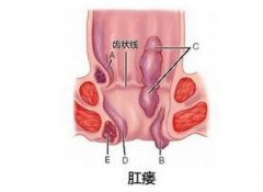 <b>肛瘘瘙痒流脓，你尴尬吗？</b>