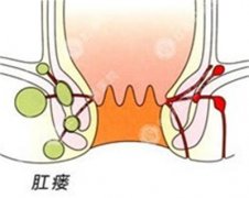 <b>肛瘘会癌变是真的吗？</b>